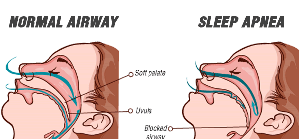Normal Airway vs Sleep Apnea