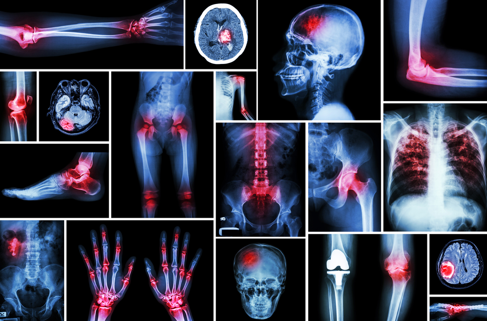 L'arthrose cannabis soulage la douleur